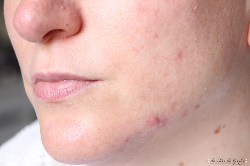 bilan roaccutane
