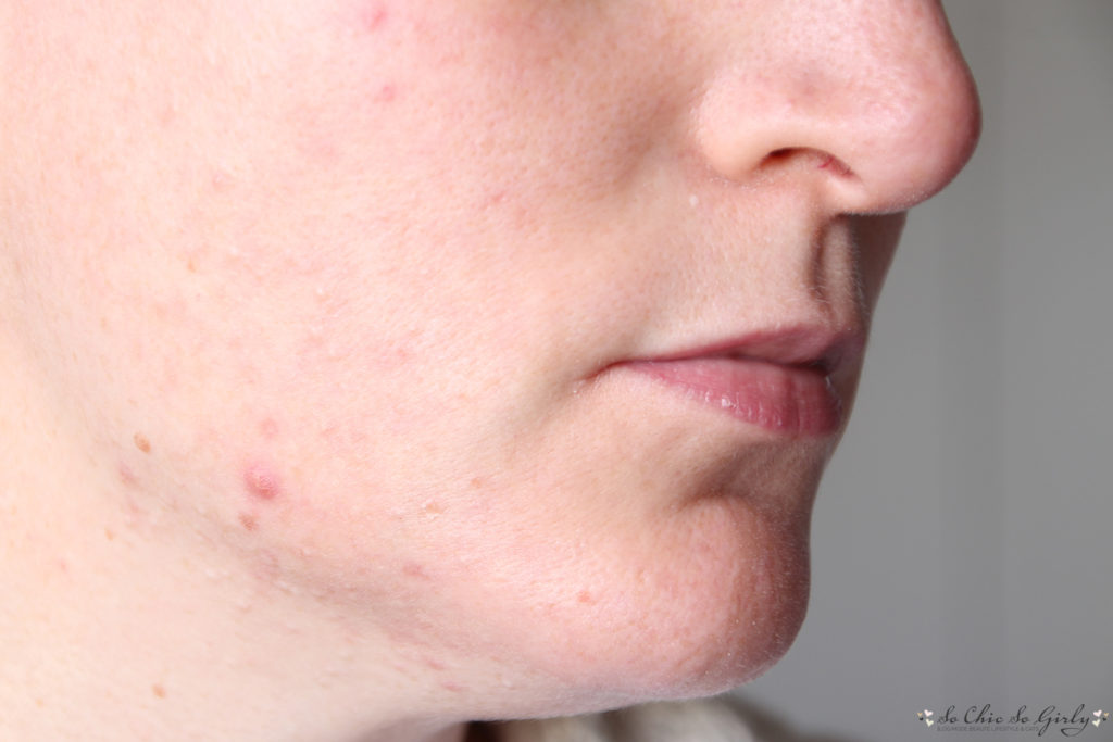 bilan roaccutane