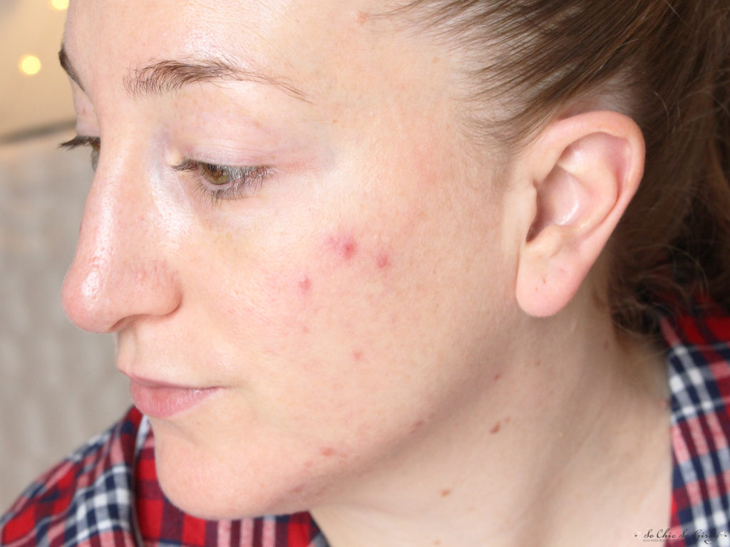 bilan roaccutane effets sur la peau