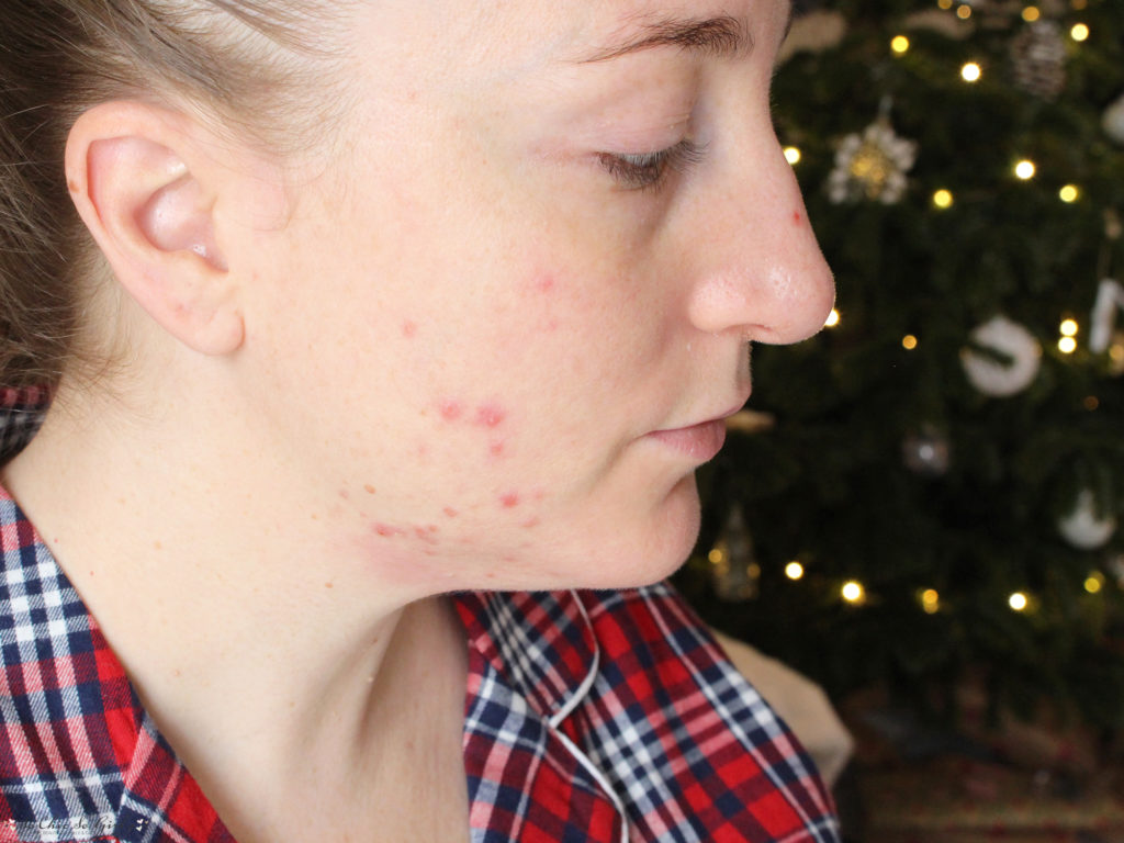 bilan roaccutane effets sur la peau