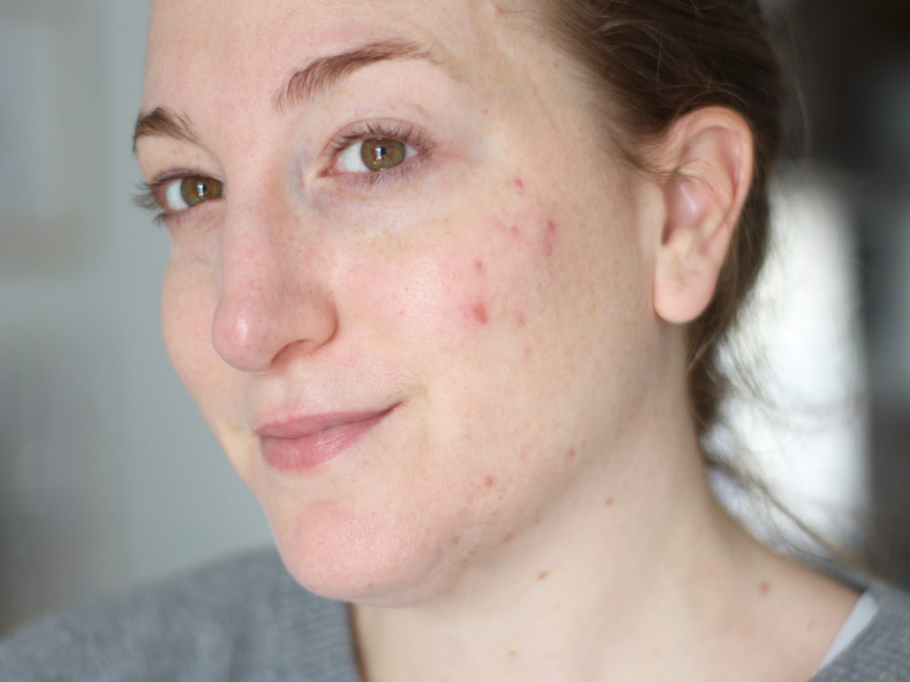 bilan roaccutane : ma peau 