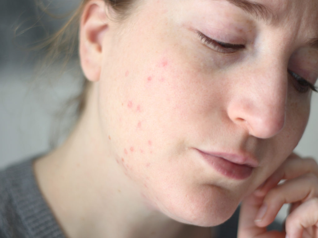 bilan roaccutane : ma peau 